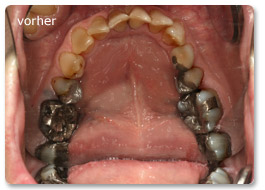 Beispiel Vollkeramik