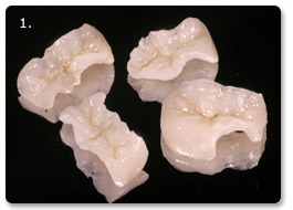 Beispiel vollkeramik