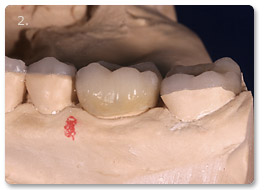 Beispiel vollkeramik