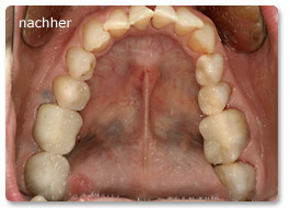 Beispiel vollkeramik