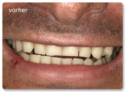 Beispiel Vollkeramik