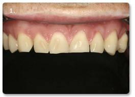 Beispiel vollkeramik