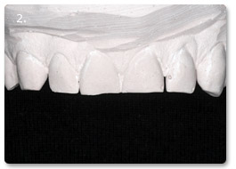 Beispiel vollkeramik