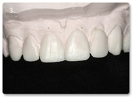 Beispiel vollkeramik