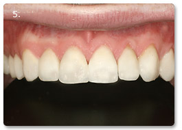 Beispiel vollkeramik