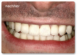 Beispiel vollkeramik