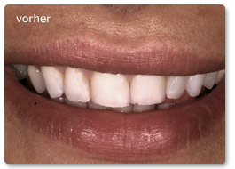 Beispiel Vollkeramik