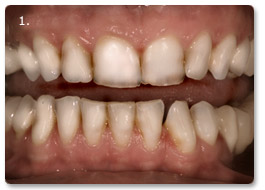 Beispiel vollkeramik