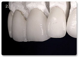 Beispiel vollkeramik