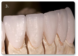 Beispiel vollkeramik