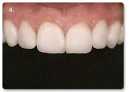 Beispiel vollkeramik