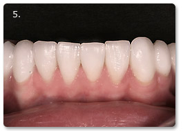 Beispiel vollkeramik