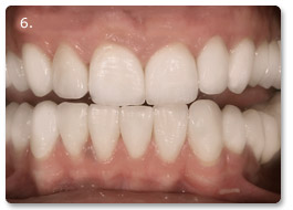 Beispiel vollkeramik