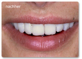 Beispiel vollkeramik