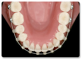 Beispiel Zahnregulierung