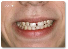 Beispiel Zahnregulierung