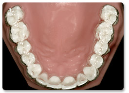 Beispiel Zahnregulierung