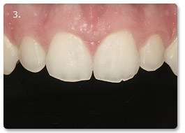 Beispiel Zahnregulierung