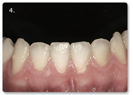 Beispiel Zahnregulierung