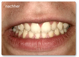 Beispiel Zahnregulierung