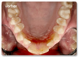 Beispiel Zahnregulierung