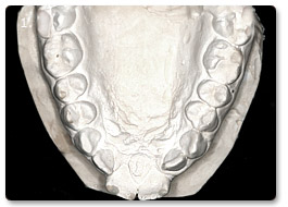 Beispiel Zahnregulierung