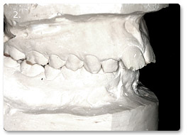 Beispiel Zahnregulierung