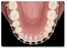 Beispiel Zahnregulierung