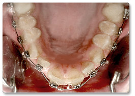 Beispiel Zahnregulierung