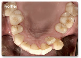 Beispiel Zahnregulierung