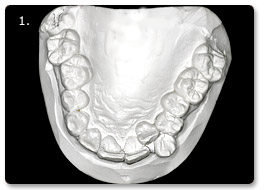 Beispiel Zahnregulierung