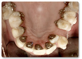 Beispiel Zahnregulierung