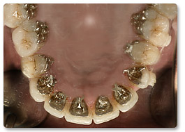 Beispiel Zahnregulierung