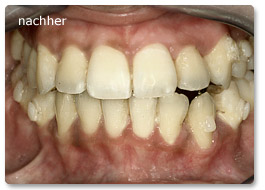 Beispiel Zahnregulierung